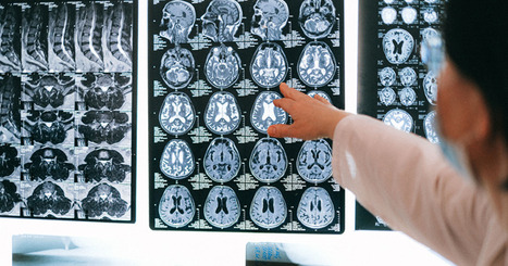 &iquest;Qu&eacute; es lo que realmente sucede cuando me diagnostican de alzh&eacute;imer? Entendiendo la enfermedad desde el cerebro&nbsp; | Alzheimer y m&aacute;s (Bolet&iacute;n n&ordm; 98) | Scoop.it