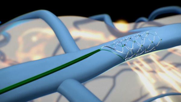 Pendant que le monde regarde Neuralink, Synchron montre comment piloter un iPad par la pensée  | Brain Computer Interfaces & connected medical devices | Scoop.it