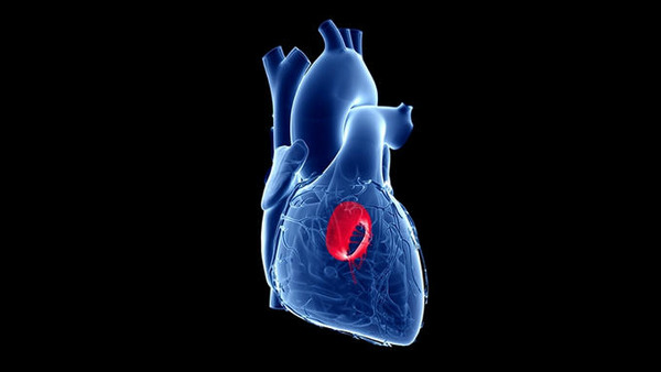 What's the Best Antithrombotic Therapy Post TMVR? | Transcatheter Treatment of Mitral Regurgitation | Scoop.it