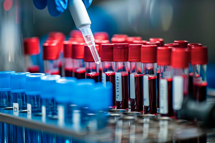 Blood Test Predicts Parkinson's Years Before Symptoms | The Health Report | Scoop.it