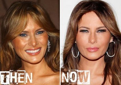 Melania Trump Plastic Surgery Before & Afte...