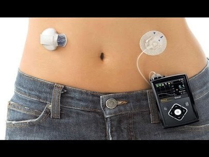 Medtronic Artificial Pancreas >> Diabetes | Scoop.it Medtronic Artificial Pancreas >> Diabetes | Scoop.it