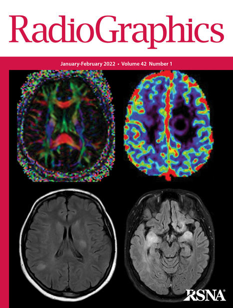 Central Nervous System Systemic Lupus Erythematosus: Pathophysiologic, Clinical, and Imaging Features | AUTOIMMUNITY | Scoop.it