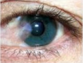 Pterigión: Una enfermedad ocular provocada por la excesiva exposición a los Rayos UV | Salud Visual 2.0 | Scoop.it