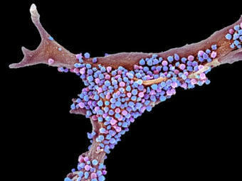 Does shingles vaccination cut dementia risk? Large study hints at a link | veille vaccination | Scoop.it