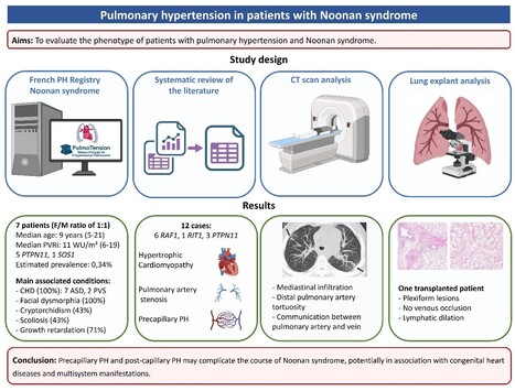 Hypertension pulmonaire associ&eacute;e au syndrome de Noonan | Life Sciences Universit&eacute; Paris-Saclay | Scoop.it