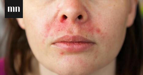 Mik&auml; on POD eli perioraalidermatiitti? N&auml;in suunymp&auml;rysihottumaa hoidetaan | 1Uutiset - Lukemisen t&auml;hden | Scoop.it