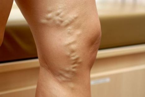 Varicose Veins: Is There Hope? By Anna Sienicka | homeopath | Scoop.it
