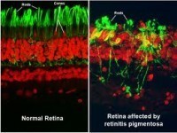 Una nueva investigación sugiere que la proinsulina puede reducir la pérdida de la visión en los modelos de retinitis pigmentosa | Salud Visual (Profesional) 2.0 | Scoop.it