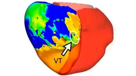Em tratamento in&eacute;dito, m&eacute;dicos tratam arritmia card&iacute;aca de risco com a ajuda de um g&ecirc;meo digital | Inova&ccedil;&atilde;o Educacional | Scoop.it