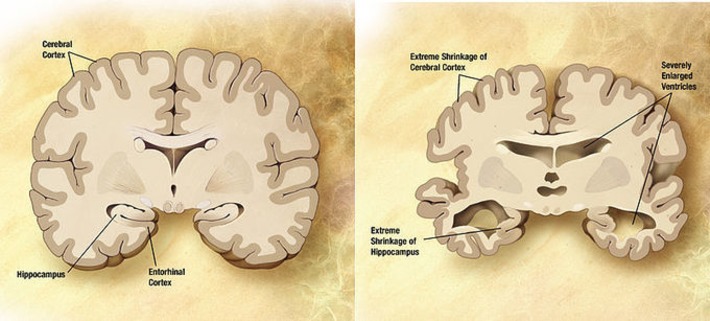 DNA methylation involved in Alzheimer's disease | Kinsanity | Scoop.it