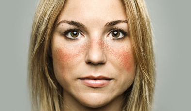 Health News - Antibody found in lupus may protect against certain ... | AUTOIMMUNITY | Scoop.it