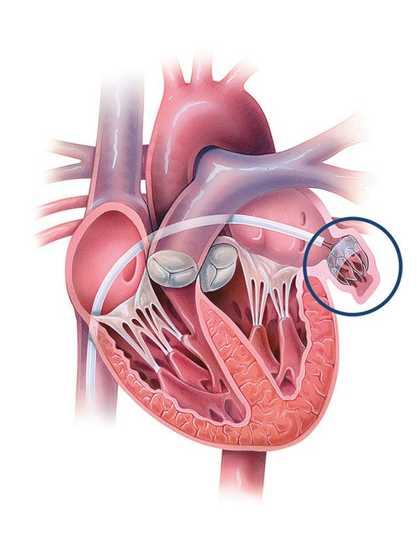 Navigating the complexities of antithrombotic therapy after LAAO | Transcatheter Treatment of Mitral Regurgitation | Scoop.it