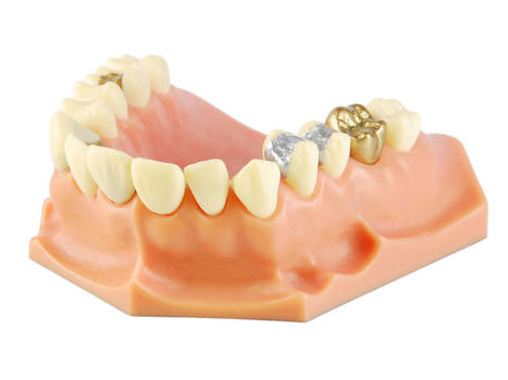 Understanding Different Types of Dental Fillings | Smilepoint Dental Group | Scoop.it