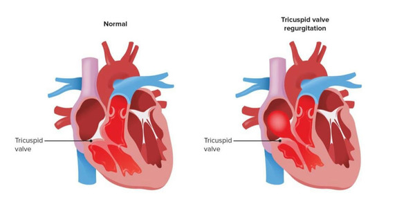 What are the benefits of valve replacement surgery? | Transcatheter Treatment of Mitral Regurgitation | Scoop.it