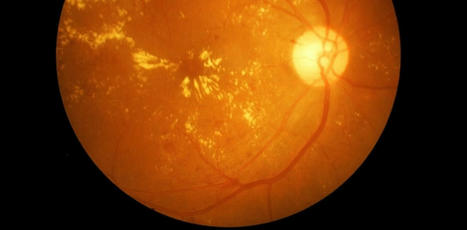 Macular diseases cause blindness and treatment costs millions. Here is how to look after yours | Hospitals and Healthcare | Scoop.it