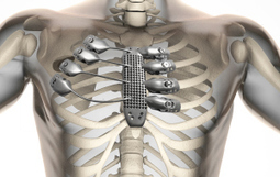 Un patient reçoit un sternum et des côtes imprimés en 3D | Libre de faire, Faire Libre | Scoop.it