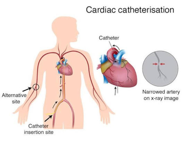 TESTS D'ÉLECTROPHYSIOLOGIE ET ​​CATHÉTÉRISME CARDIAQUE | Interventional Cardiology | Scoop.it