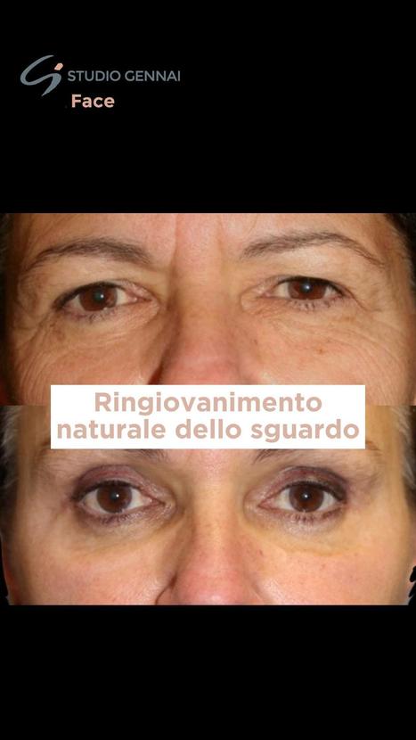 Tecniche avanzate contro l'invecchiamento dello sguardo | Dr. Alessandro Gennai | Medicina Estetica News | Scoop.it