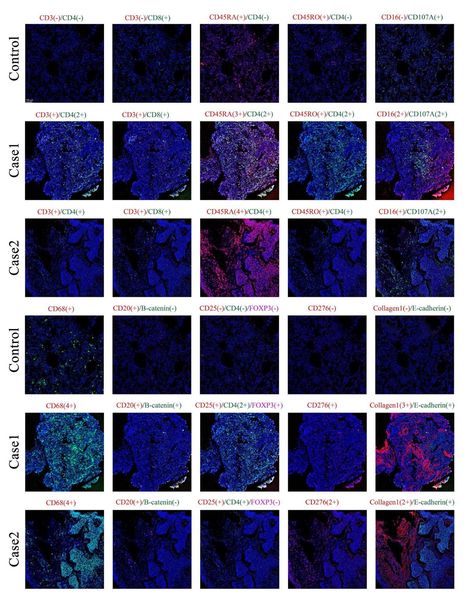 Inflammatory Response Cells During Acute Respiratory Distress Syndrome in Patients With Coronavirus Disease 2019 (COVID-19) | Annals of Internal Medicine | American College of Physicians | Mucosal Immunity | Scoop.it