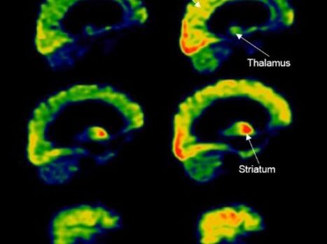 Après 15 ans en état végétatif, il retrouve des signes de conscience après stimulation | Dépendance et fin de vie | Scoop.it
