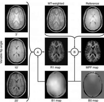 MRI Shows Gray Matter Myelin Loss Strongly Related to MS Disability | Kinsanity | Scoop.it