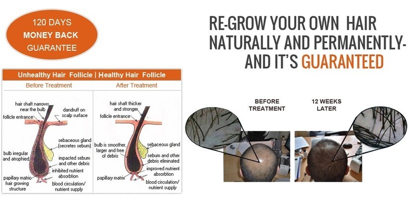 Laser Hair Gain Therapy For Men And Women Eff