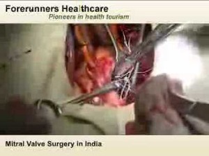 Mitral heart valve replacement surgery in India | Transcatheter Treatment of Mitral Regurgitation | Scoop.it