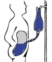 Peritoneal Dialysis for FSGS How to Extend Life Expectancy | Peritoneal dialysis | Scoop.it