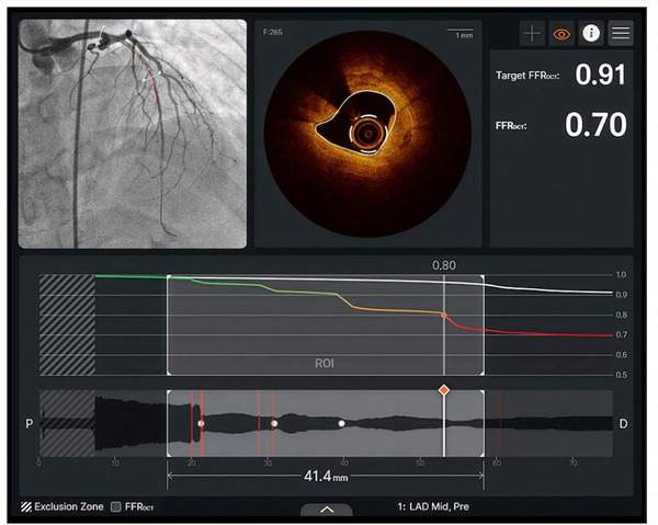 FDA Clears Optical Coherence Tomography System for AI-Enabled High-Resolution Imaging of Coronary Plaque&nbsp; | Interventional Cardiology | Scoop.it