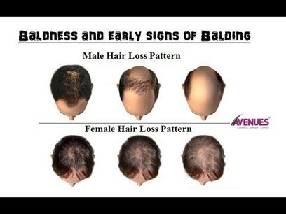 Prevent Yourself From Early Baldness Hair Tra