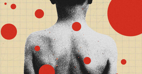 The Backward Logic of Chickenpox Parties | H&eacute;sitations Vaccinales: Observatoire HESIVAXs | Scoop.it