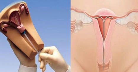 Những điều cần biết về phương pháp tránh thai bằng đặt vòng | Mai95 | Scoop.it