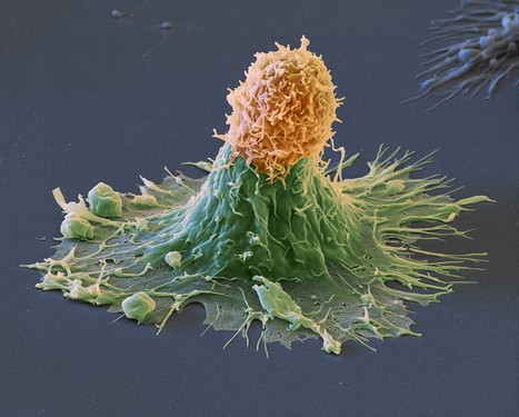 CRISPR-Based Anti-CD19 CAR T-Cell Therapy Is Safe and Effective in Relapsed/Refractory NHL | Genetic Engineering in the Press by GEG | Scoop.it