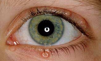 Une augmentation des cas de syphilis oculaire est signalée aux États-Unis | sida | Scoop.it