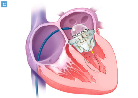 Percutaneous Transseptal Transcatheter Mitral Valve Replacement System Provides Treatment Option for Patients Who Are Not Candidates for Surgery or TEER  | Transcatheter Treatment of Mitral Regurgitation | Scoop.it