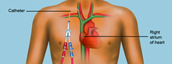Types of Dialysis Access | Peritoneal dialysis | Scoop.it