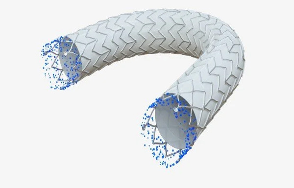 Revolutionising care: Drug-eluting stent platform designed to address edge restenosis poised to deliver next-generation solution in dialysis access circuit maintenance | Interventional Cardiology | Scoop.it