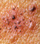 Shingles Vaccine Deemed Safe in Large Study | Virology News | Scoop.it