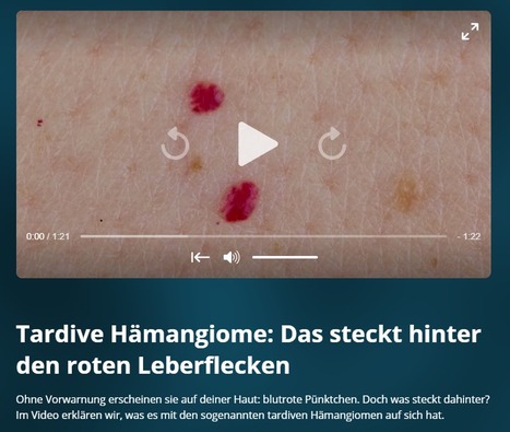 Tardive Hämangiome: Das steckt hinter den roten Leberflecken | Galileo |  | 21st Century Innovative Technologies and Developments as also discoveries, curiosity ( insolite)... | Scoop.it