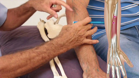 Trigger Points Affecting The Fingers | Call: 915-850-0900 | Mobility & Flexibility - Joint Movement | Scoop.it