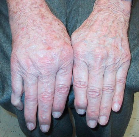2023 ACR/EULAR Criteria for Calcium Pyrophosphate Deposition Disease | RheumNow | Rheumatology-Rhumatologie | Scoop.it