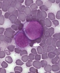 In leukemia, discovery of Mer protein in cancer cells' nuclei offers ... | Hematology | Scoop.it