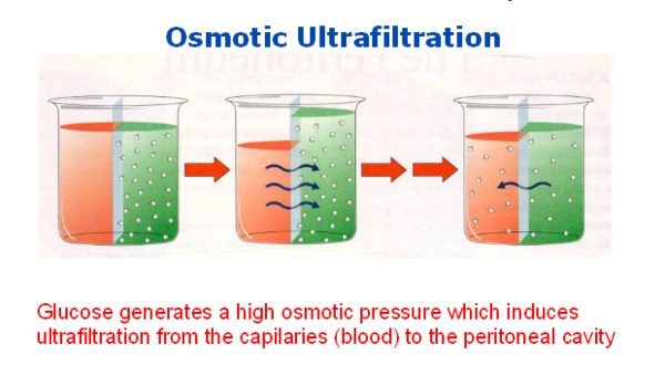 Acquired Decline in Ultrafiltration in Peritoneal Dialysis: The Role of Glucose | Peritoneal dialysis | Scoop.it