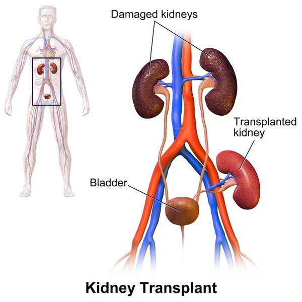 Kidney Transplant Explained | Peritoneal dialysis | Scoop.it