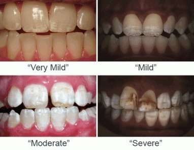 SWALLOW THIS: Fluoride “Multi-Vitamins, Drops, Tablets” Are Not FDA-Approved, But Are Still Being Sold To American Children - BolenReport | Health Supreme | Scoop.it