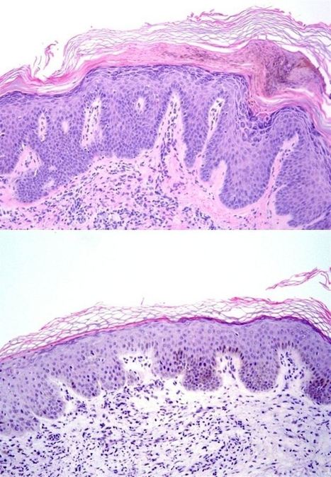 Investigadores del CNIO proponen dos nuevas vías para tratar la psoriasis | Immunopathology & Immunotherapy | Scoop.it