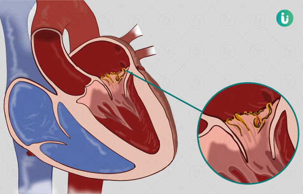 Benefits of On-X Mitral Valve Replacement in Cases of Infective Endocarditis | Transcatheter Treatment of Mitral Regurgitation | Scoop.it