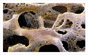 Denosumab for the treatment of osteoporosis | Rheumatology-Rhumatologie | Scoop.it