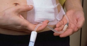 State-wide free dialysis program will be rolled out statewide: What is Peritoneal Dialysis? | Peritoneal dialysis | Scoop.it